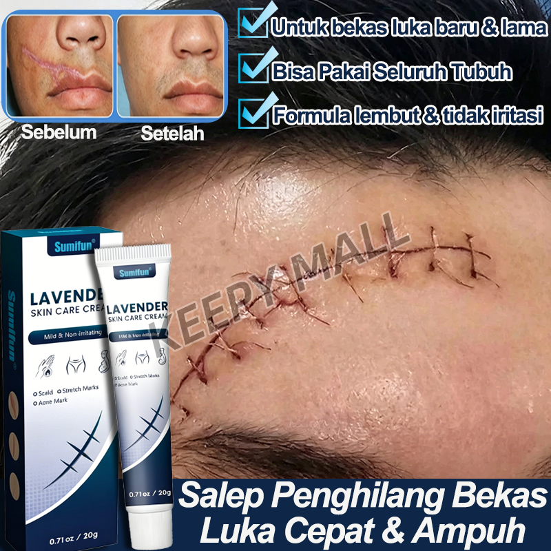 Salep Penghilang Bekas Luka Hitam Koreng Di Kaki Obat Bekas Luka Stretch Mark Cream Menghilangkan Be