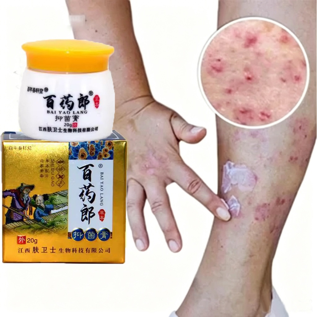Salep gatal china paling ampuh salep gatal jamur selangkanga Krim Eksim Bayi dan Anak Obat gatal sel