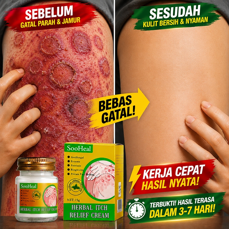 Salep Kulit Jamur,Salep gatal psoriasis,Pk untuk gatal,15g,Cepat Redakan Segala Jenis Gatal Kulit,Re