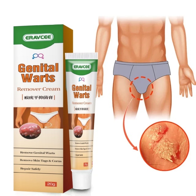 Obat kutil kelamin Penghilang Kutil Kelamin Obat Kutil Kelamin HPV Penghilang kutil dan tahi lalat
