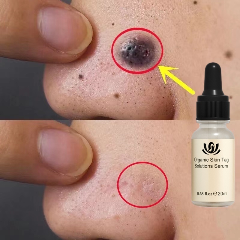 Minyak Esensial Penghilang Tahi Lalat Wajah Menghilangkan Tuntas Bintik Hitam Nevus Alami