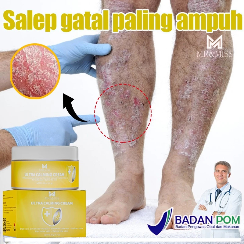Salep gatal selangkangan Saleb gatal paling ampuh obat psoriasis penghilang kurap dan jamur kulit 20