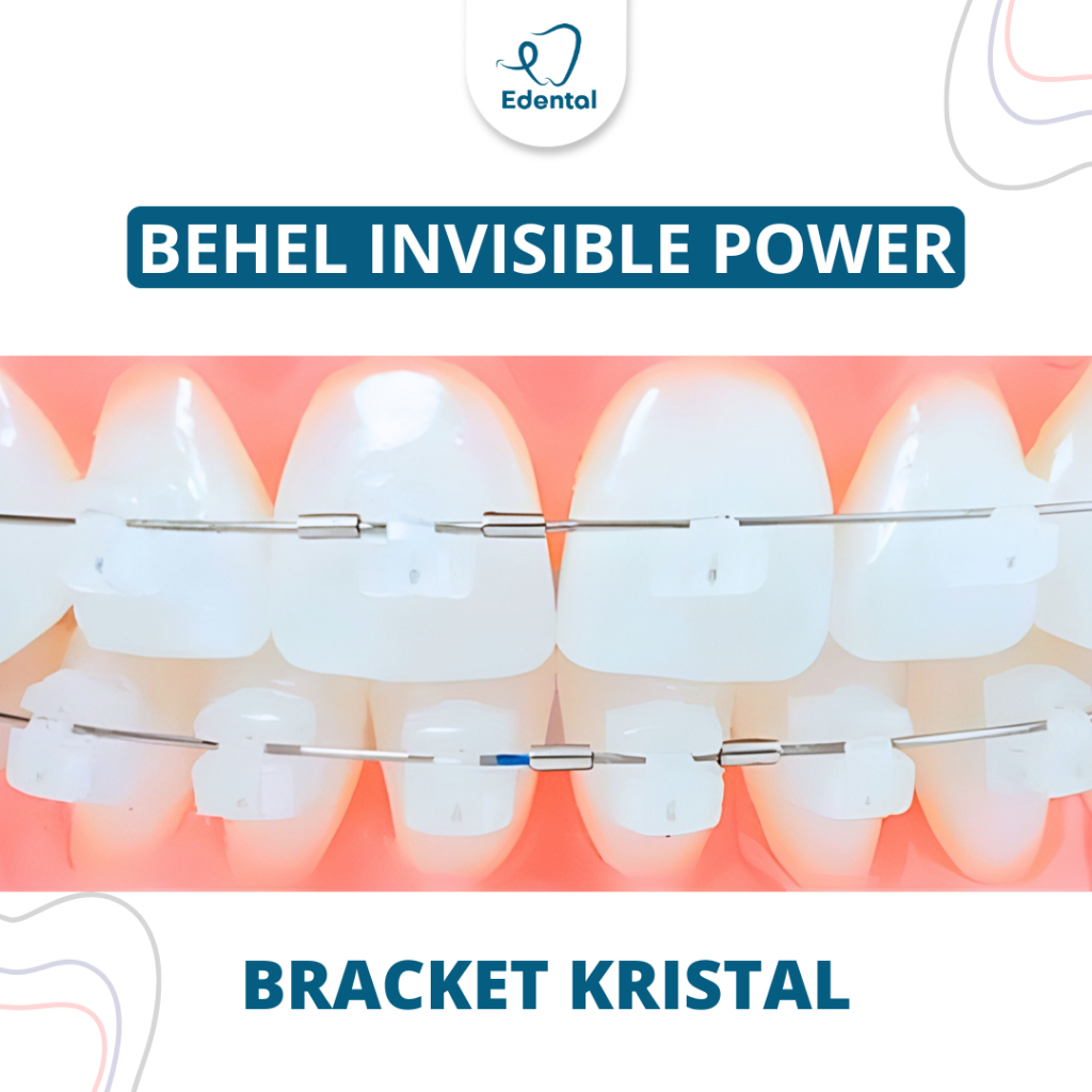 Pasang Behel Invisible Power Zirconia Edental - Perawatan Kawat Gigi Estetik Warna Gigi Transparan
