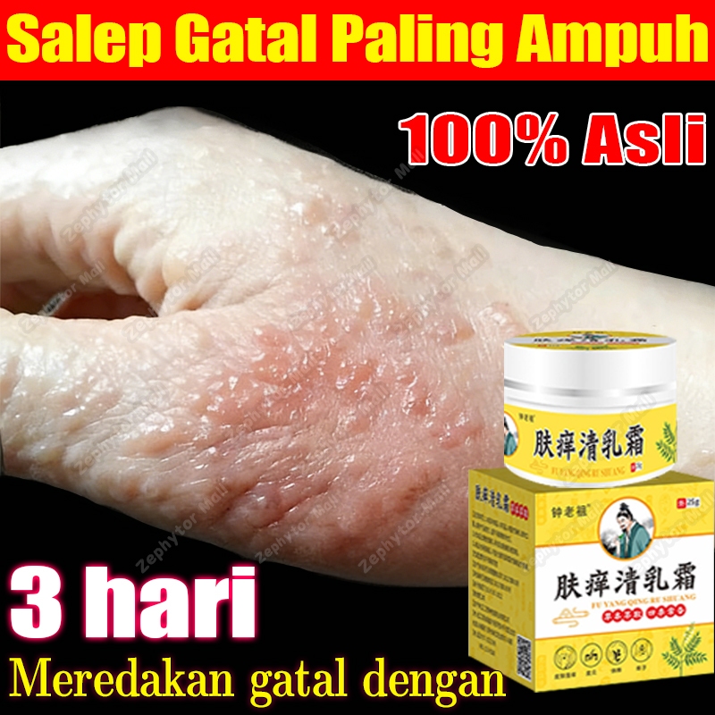 salep eksim kering paling ampuh 25g psoriasis cream obat gatal selangkangan salep gatal bayi  Menghi