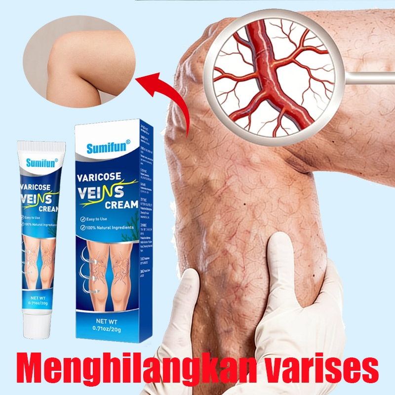 Varicose Veins Cream Varises Salep Penghilang Varises Vaskulitis Veins Salep Cream Varises Kaki dan 