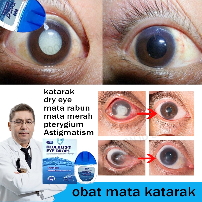 Obat mata katarak Blueberry Eye drop Obat mata merah Pengobatan mata rabun mata buram mata kering sa