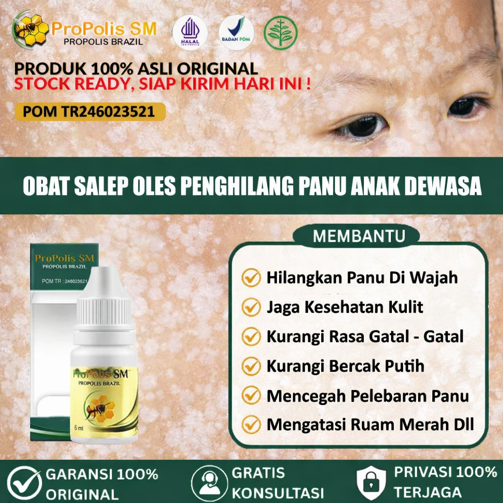 Obat Panu Anak, Di Wajah Anak, Obat oles Penghilang Panu Untuk Anak, obat panu   anak untuk di wajah