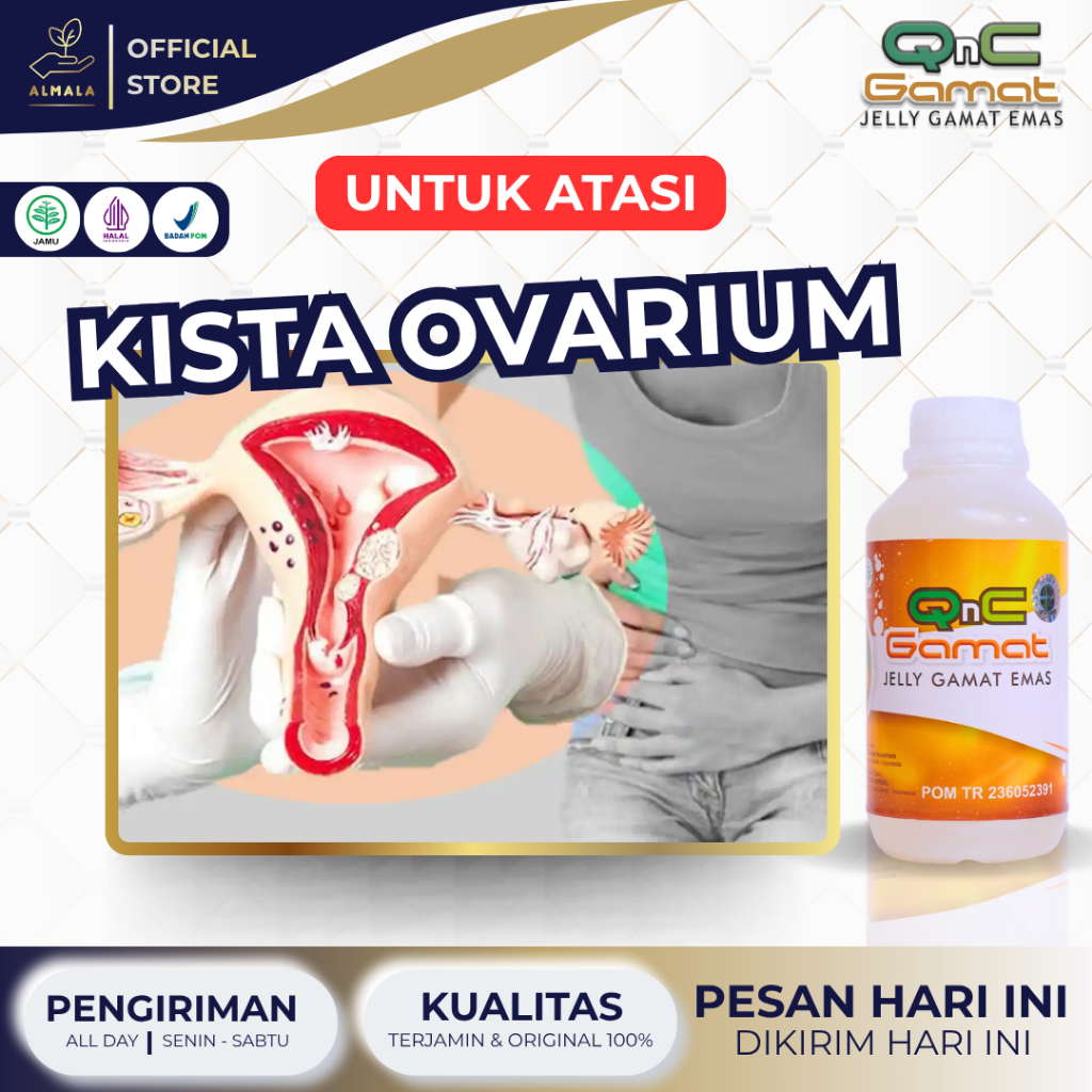 Obat Kista Ovarium, Penghancur Kista Ovarium, Kista Miom, Kista Rahim, Kista Coklat, Kista Endometri