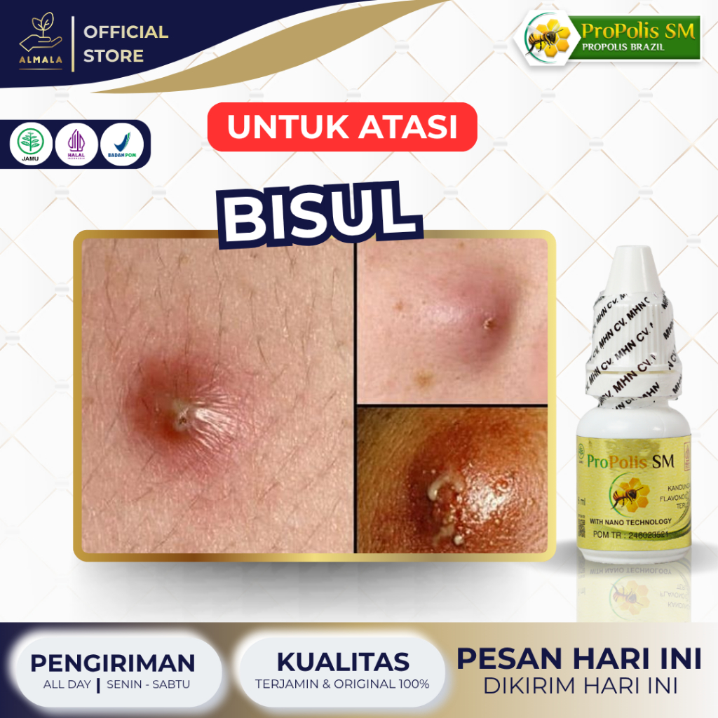 Obat Bisul, Obat Bisul Meradang, Obat Bisul di Pantat, Obat Pengempes Bisul, Obat Bisul Bernanah, Ob
