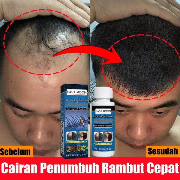 Obat Penumbuh  rambut cepat dan tebal perawatan rambut pria Ampuh hair tonic rambut rontok Pria miny