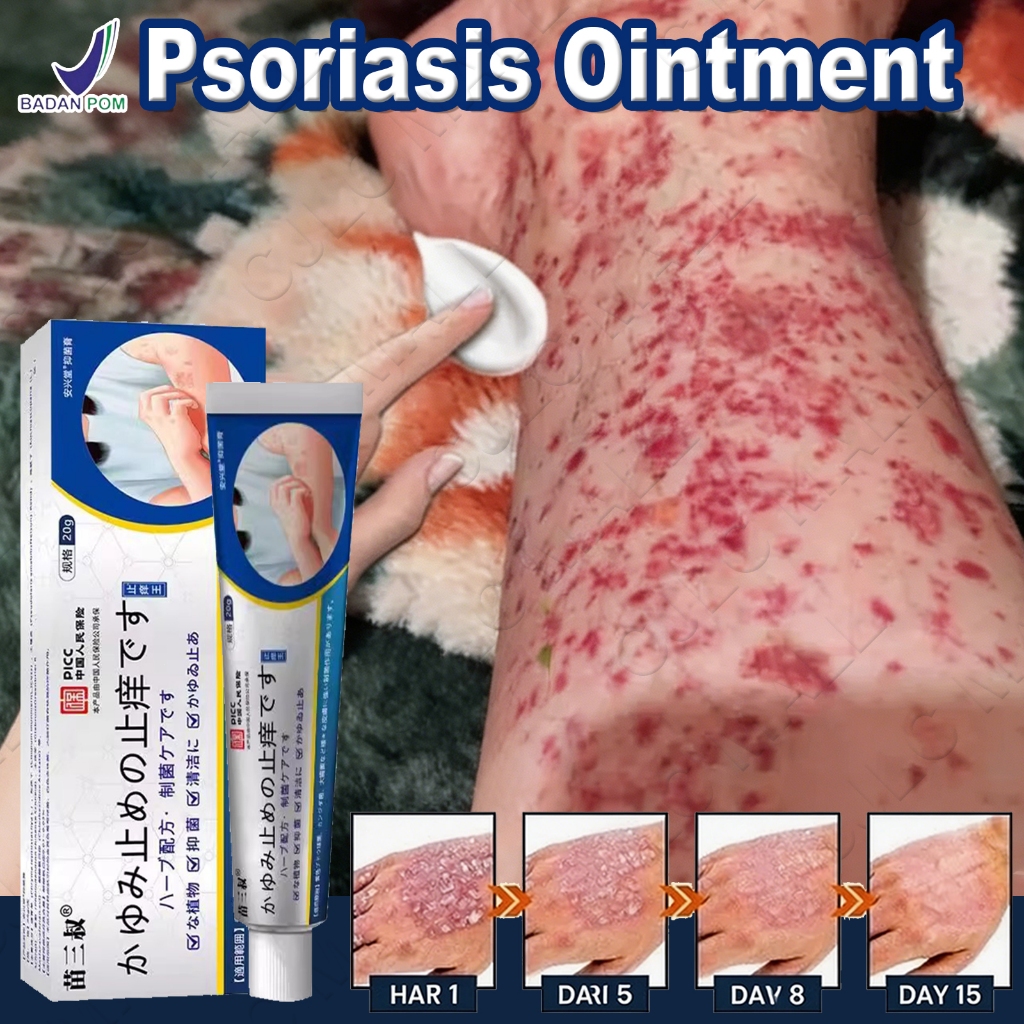 Salep Gatal Kulit  Salep psoriasis salep gatal selangkangan obat alergi gatal kulit Kulit Kepala Pso
