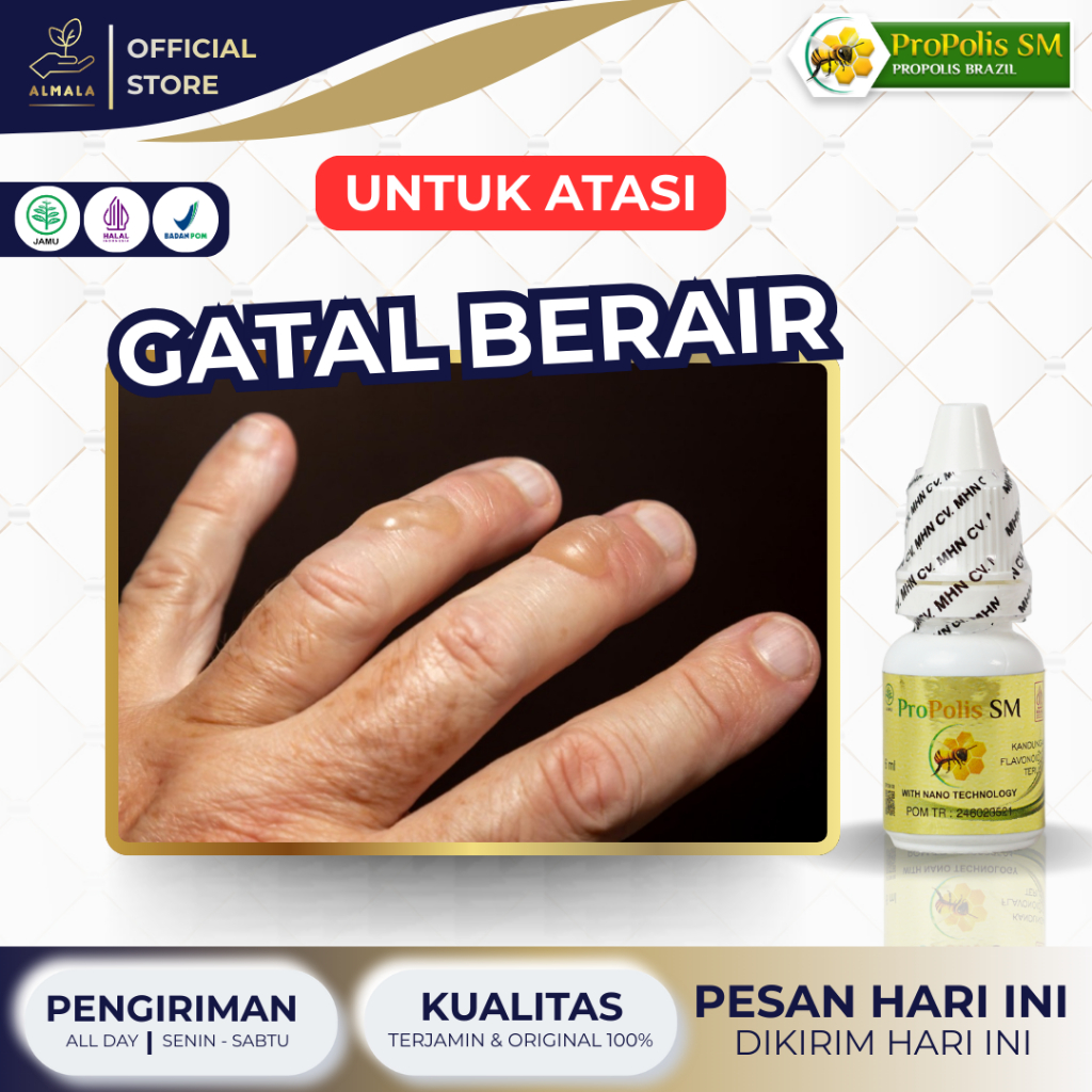 Obat Gatal Berair, Gatal Bintik Berair, Gatal Berair Di Jari Tangan Dan Kaki, Gatal Bintik Berair, B