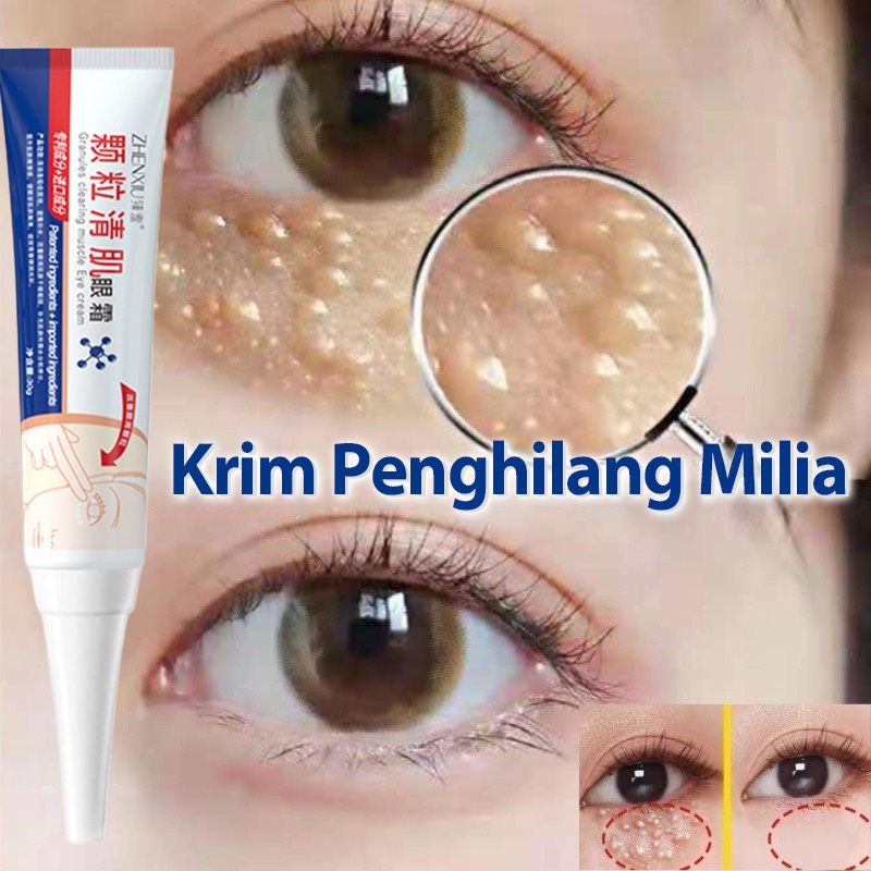 Krim Penghilang Milia Salep Mata 30Gr Bintitan Eye Cream Penghilang Milia Syringoma Xanthelasma