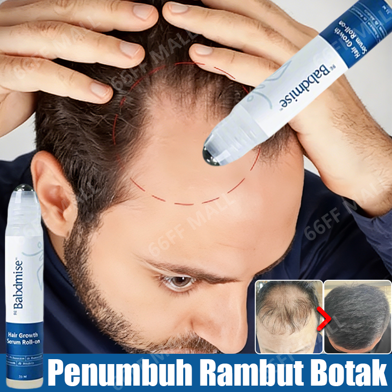serum rambut rontok Roller 3% rosemary oil rambut penumbuh rambut cepat dan tebal hair serum penumbu