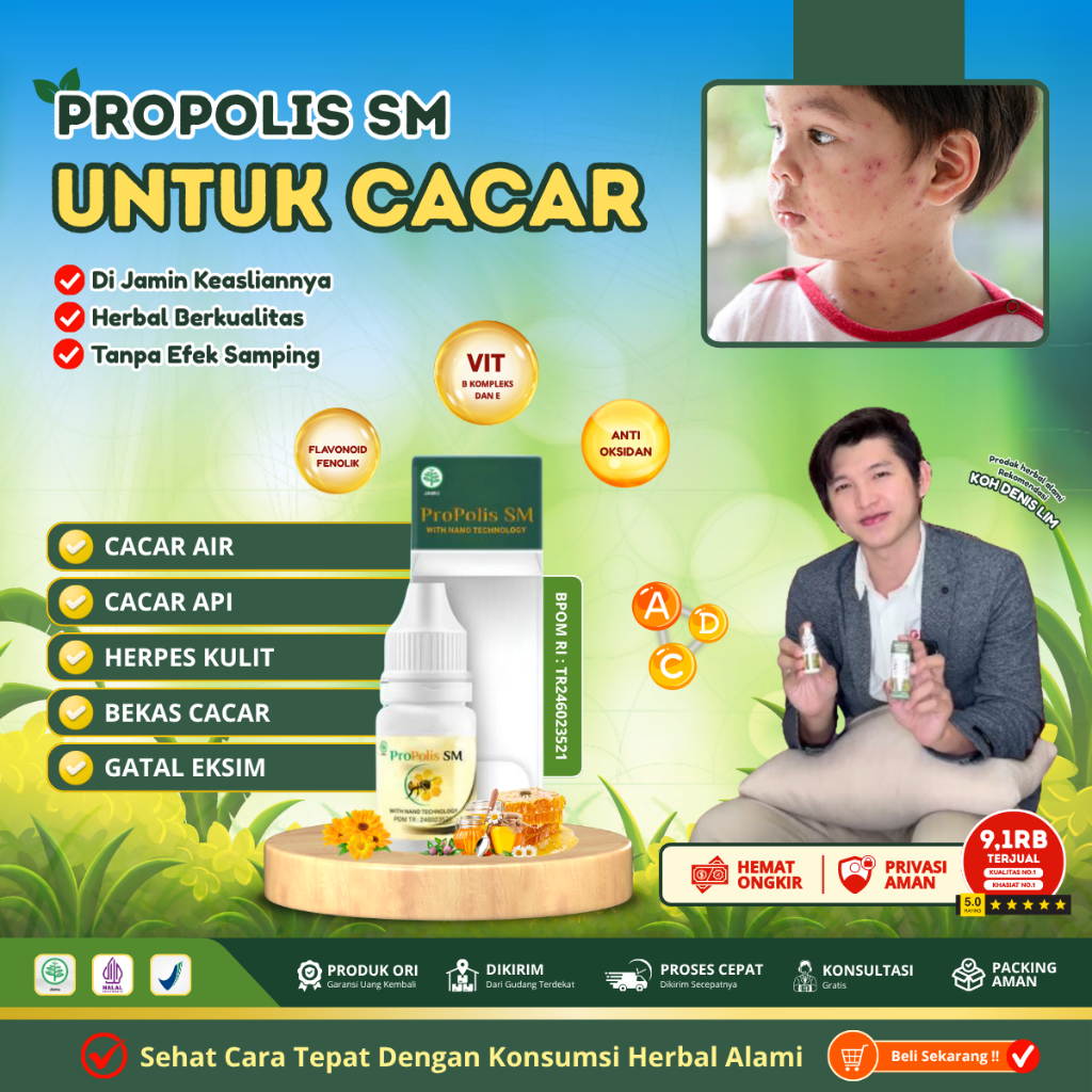 Penghilang cacar air dan Bekas Cacar, Obat dompo anak / herpes zoster gatal berair, Obat cacar api g