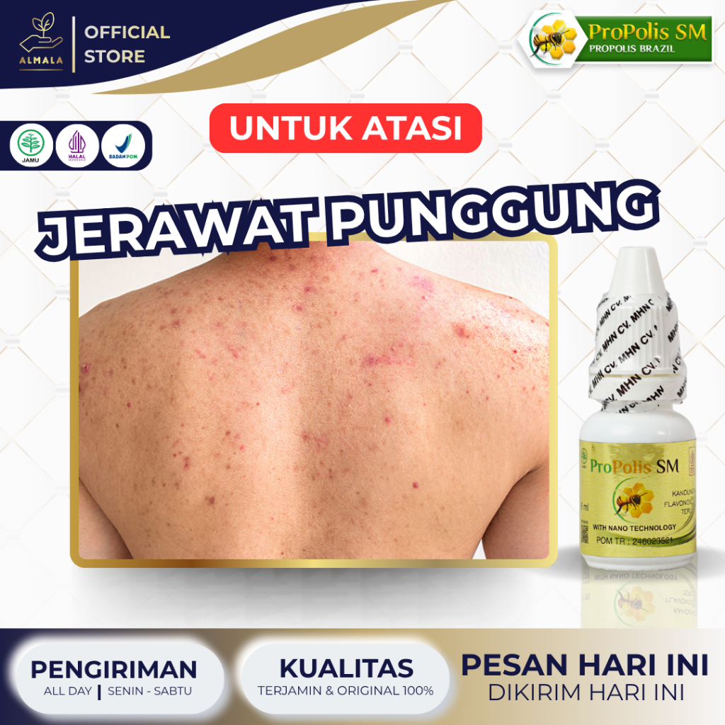 Obat Jerawat Punggung, Penghilang Jerawat di Punggung, Punggung Jerawatan, Gatal Di Punggung, Jerawa