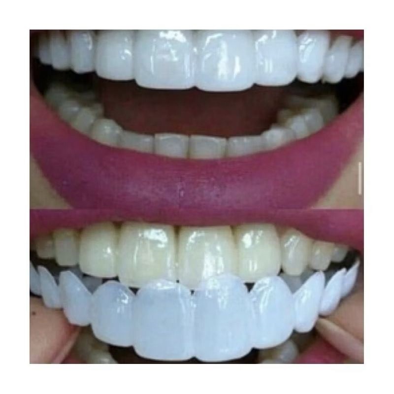 VENEER GIGI ATAS BAWAH - LEPAS PASANG SIAP PAKAI INSTANT