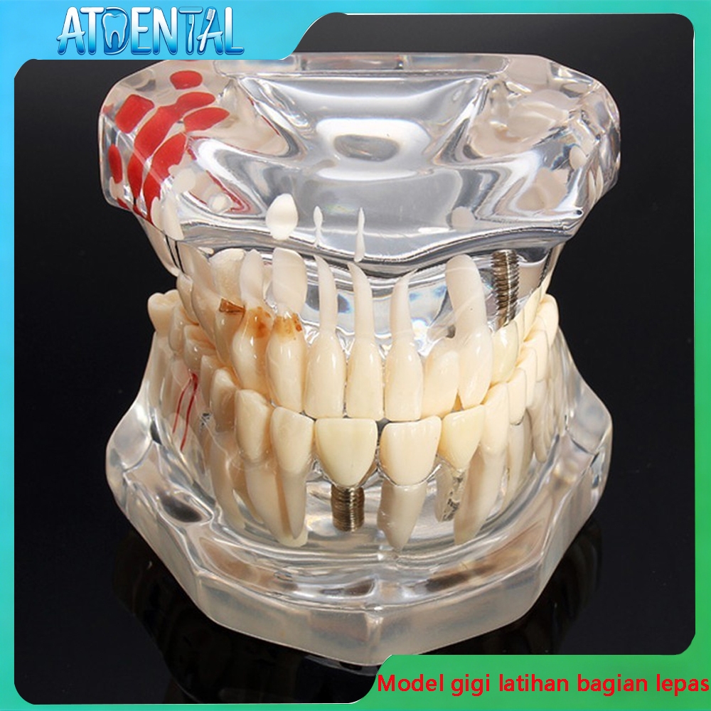 Model Gigi Transparan Study Phantom Removable Model Implan Latihan Bisa Lepas - Ready Stock COD