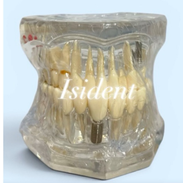 Model study gigi edukasi transparan bisa dillepas studi implant phantom crown karies bridge bening i