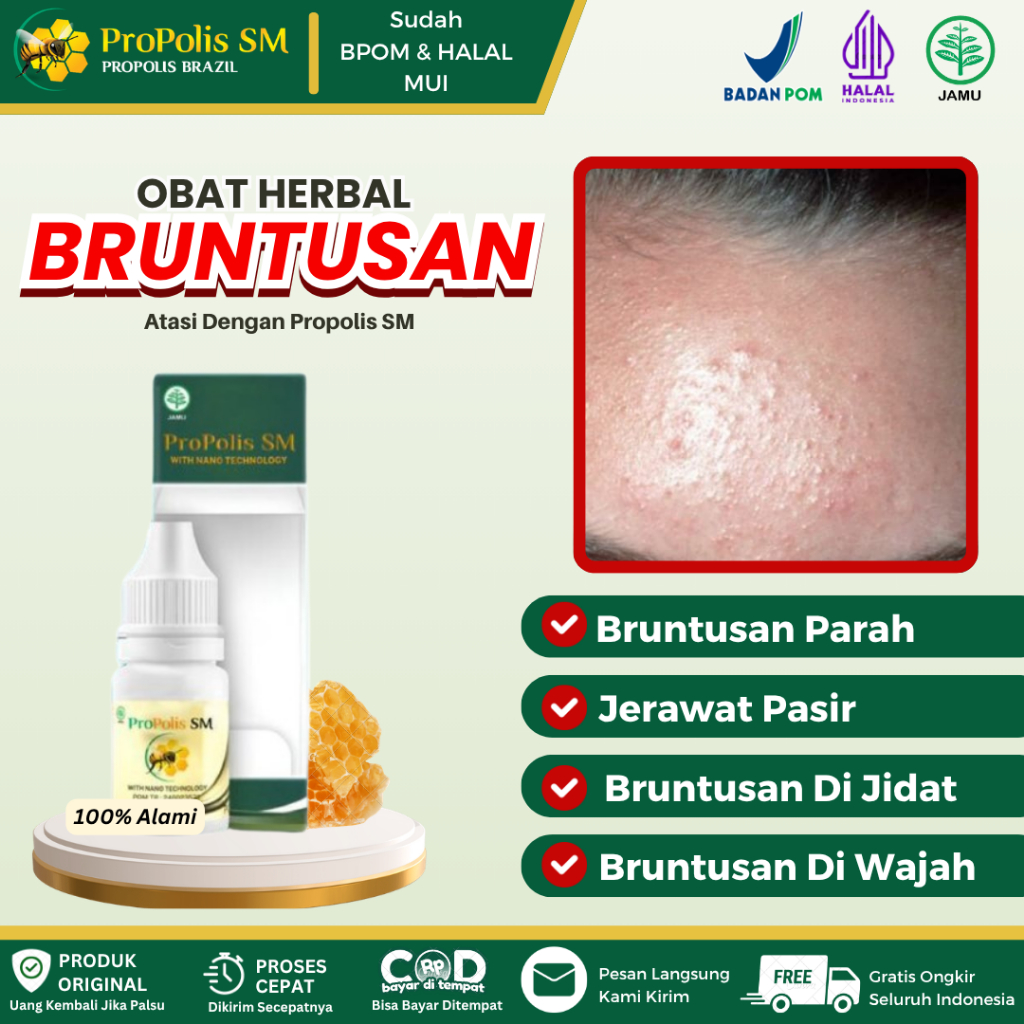 Obat Bruntusan, Bruntusan Di Wajah, Bruntusan Di Jidat, Bruntusan Parah, Jerawat Pasir, Menghilangka