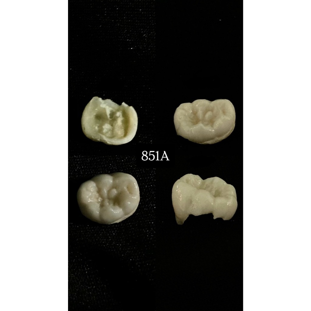 Gigi 85 (Gigi Praktikum Asli Pedo Anak Posterior Molar)