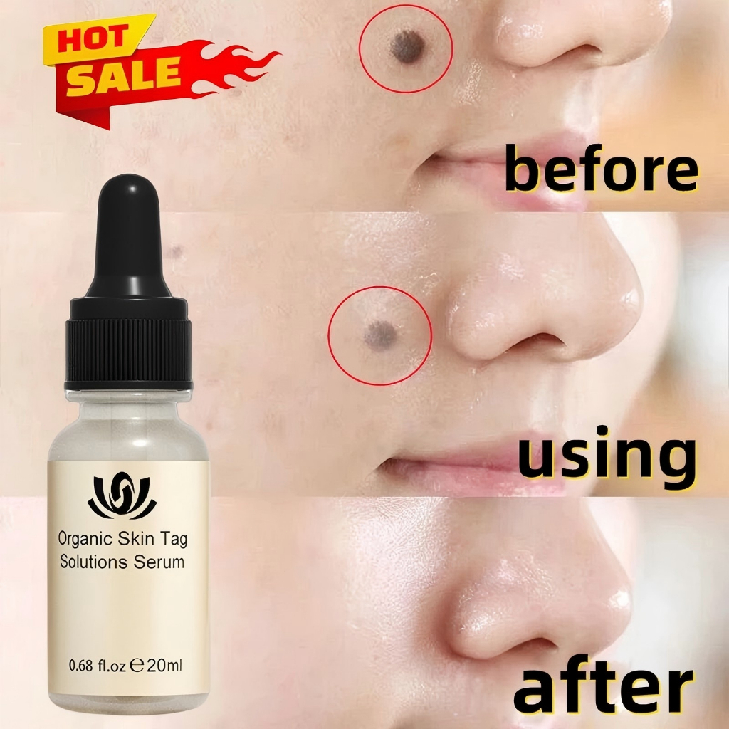 Penghilang Tahi Lalat Penghilang Kutil Obat Tahi Lalat Di Wajah Remover Bintik Skin Tag Remover Tanp