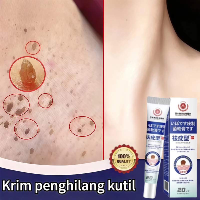 Obat kutil Penghilang kutil Salep kutil paling ampuh Menghilangkan kutil dan tahi lalat Kutil Di Waj