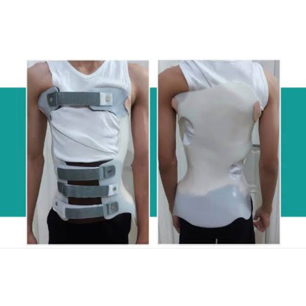 mso scoliosis brace