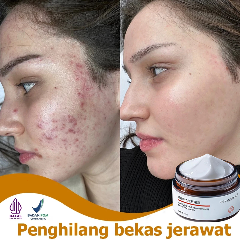 Krim Penghilang Bekas Jerawat Obat bekas jerawat penghilang bekas jerawat 50g obat totol jerawat pen
