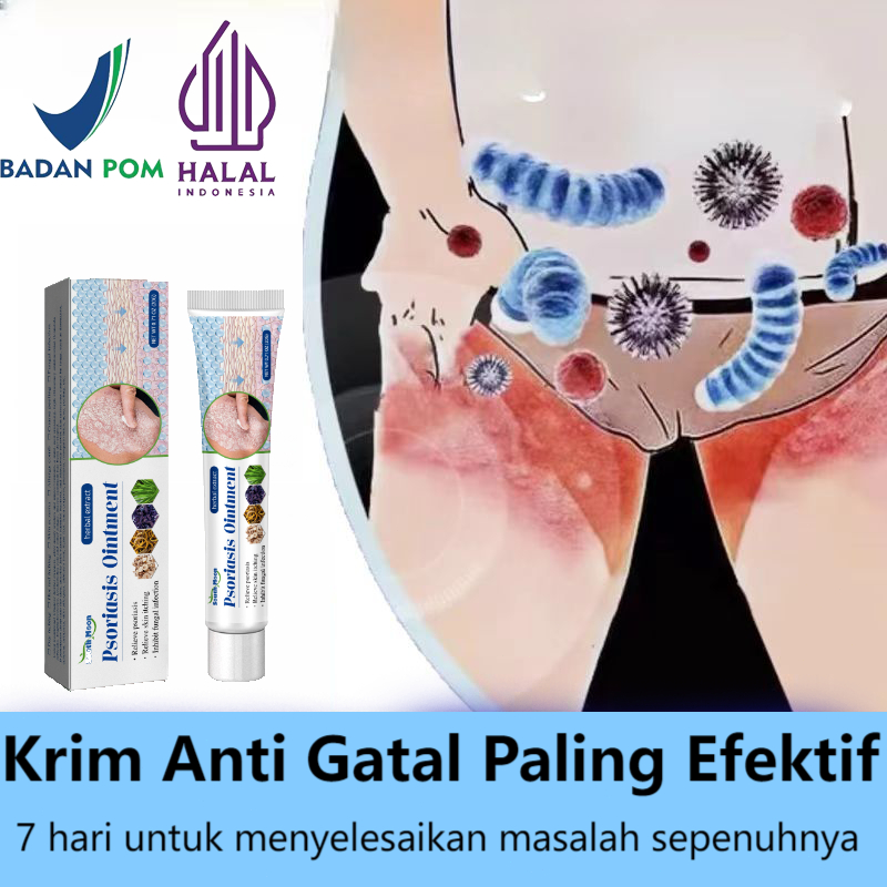 Salep gatal china paling ampuh salep gatal jamur selangkanga Krim Eksim Bayi dan Anak Obat gatal sel