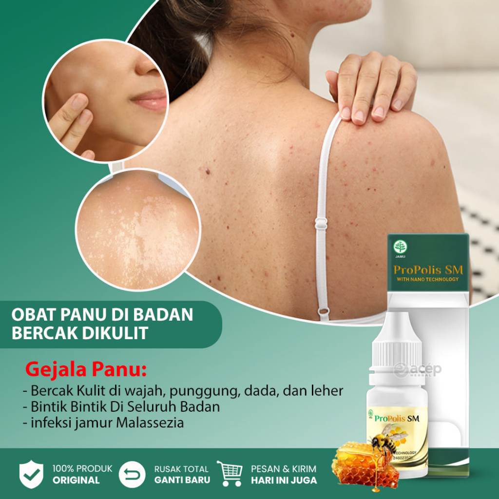 Obat Panu, Penghilang Panu, Obat Panu Anak, Obat Panu Dewasa, Obat Hapur Kulit, Panu di Punggung, Pa