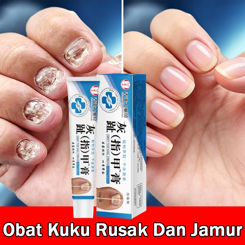 Obat Jamur Kuku Obat Cantengan Salep Kuku Rusak Dan Berjamur Pembersih Kuku Kaki Hitam Obat Kuku Ber