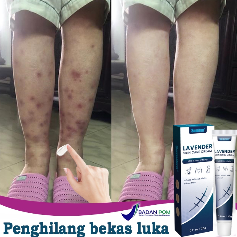 COD Menghilangkan bekas luka dengan cepat Penghilang Bekas Luka Koreng Advanced Scar Gel Obat Bekas 