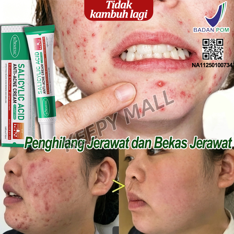 Krim Penghilang Bekas Jerawat Dan Noda Hitam Obat Totol Jerawat Dan Bekas Jerawat Acnes Salep Jerawa