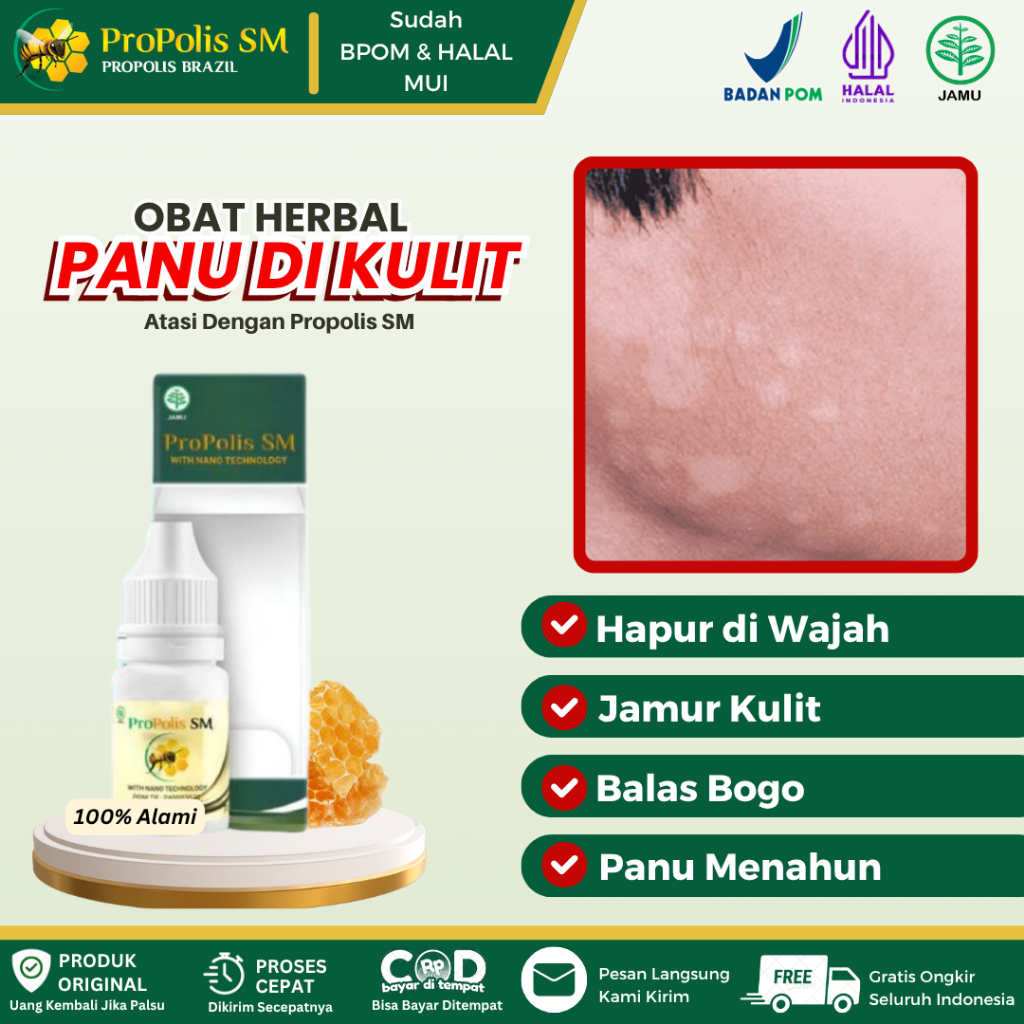 Obat Panu Anak, Panu Kulit, Panu di Wajah Anak & Dewasa, Hapur di Wajah, Hapuran Kulit, Jamur Kulit 