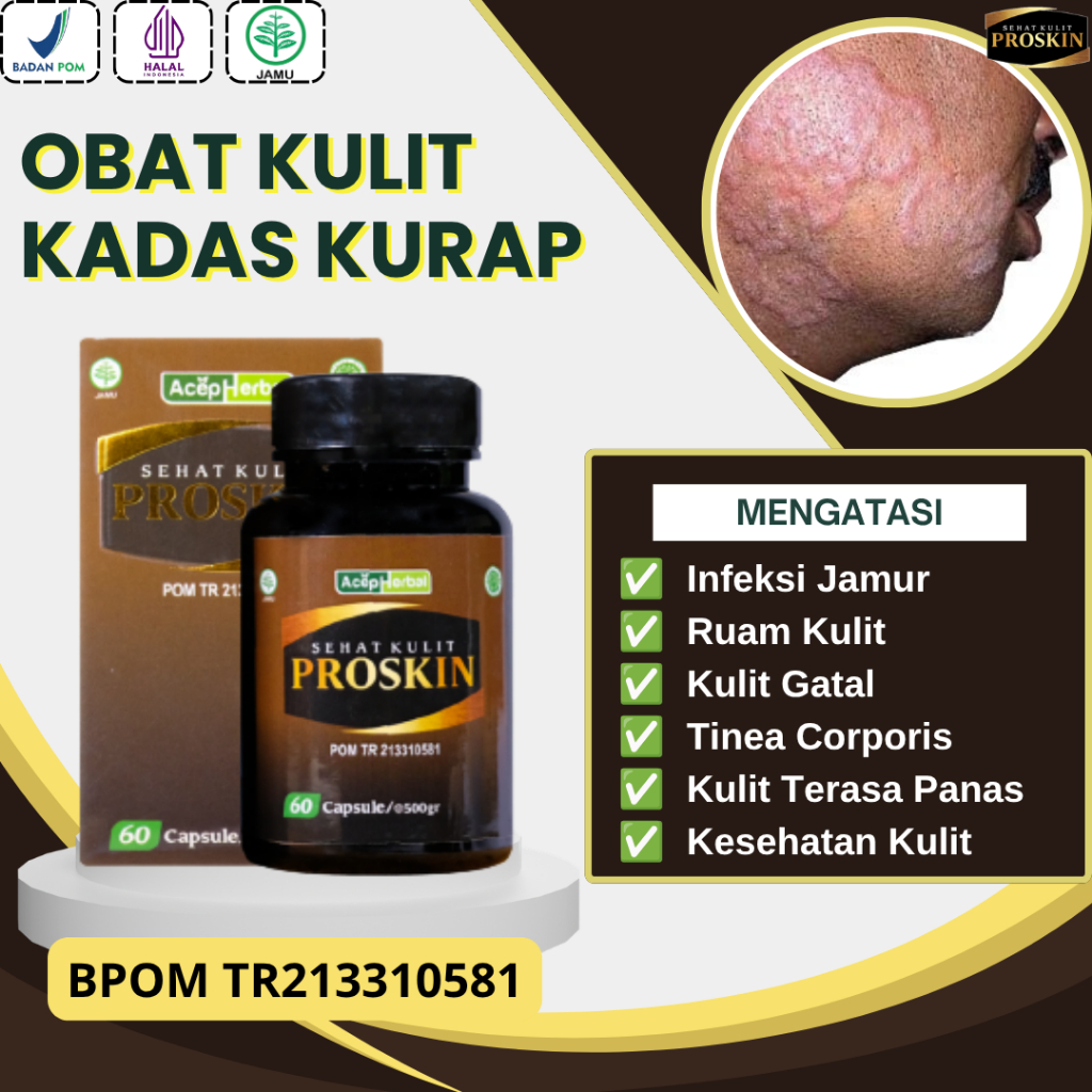 Obat Kulit Kurap Kadas Infeksi Jamur Ruam Merah Terasa Gatal, Obat Tinea Corporis dengan Kapsul Pros
