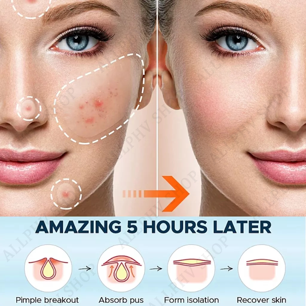 ALLPHV Acne Treatment Patches / Acne Pimple Patch Sticker 22pcs Detachable Penghilang Jerawat Stickers Day &amp; Night