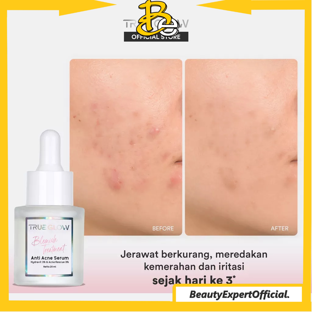 ⭐️ Beauty Expert ⭐️ TRUE GLOW Blemish Treatment Anti Acne Serum - Serum Jerawat, Bruntusan, Berminyak