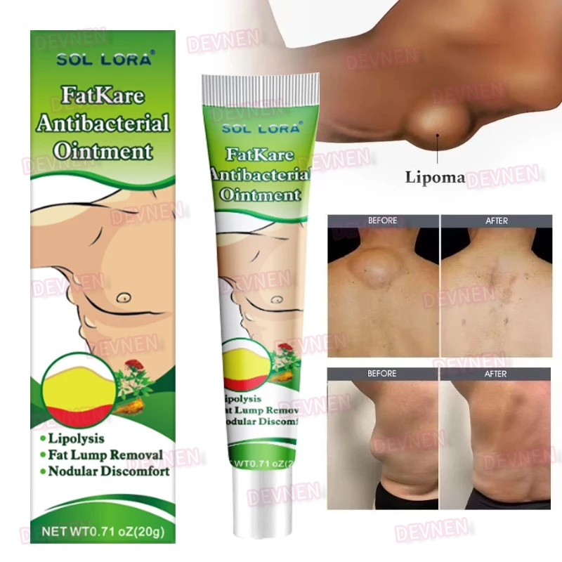 Lipoma Cream 20G Salep Lipoma Salep Benjolan Obat Lipoma Obat Benjolan Penghilang Benjolan Aman Dan Tanpa Efek Samping, Sembuh Total Tanpa Meninggalkan Akar
