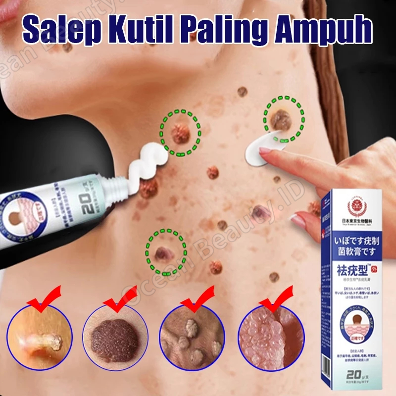 Salep Penghilang Tahi Lalat Penghilang Kutil Di Leher Obat Kutil Kelamin Salep Kutil Di Wajah Obat M