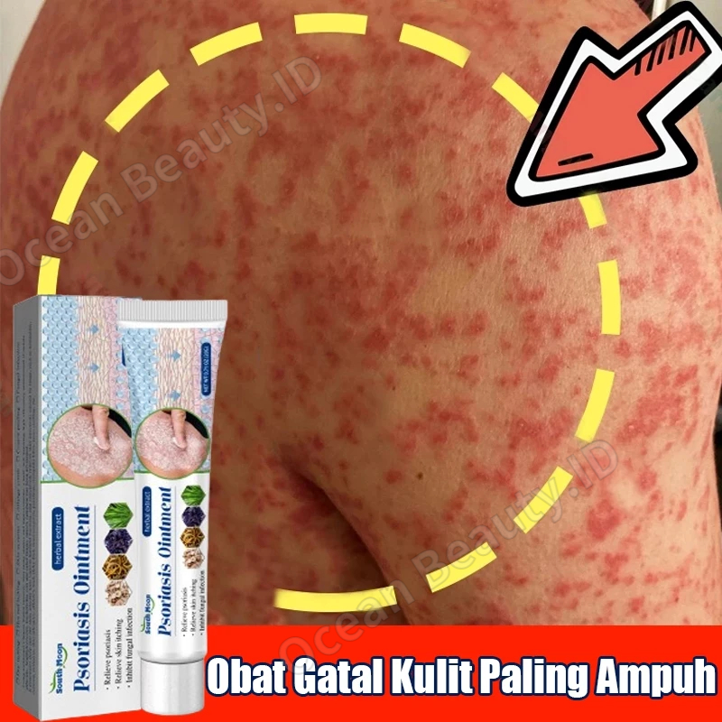 salep eksim kering dan gatal Salep Gatal Salep Eksim Obat Psoriasis Salep Psoriasis Obat Gatal Kulit