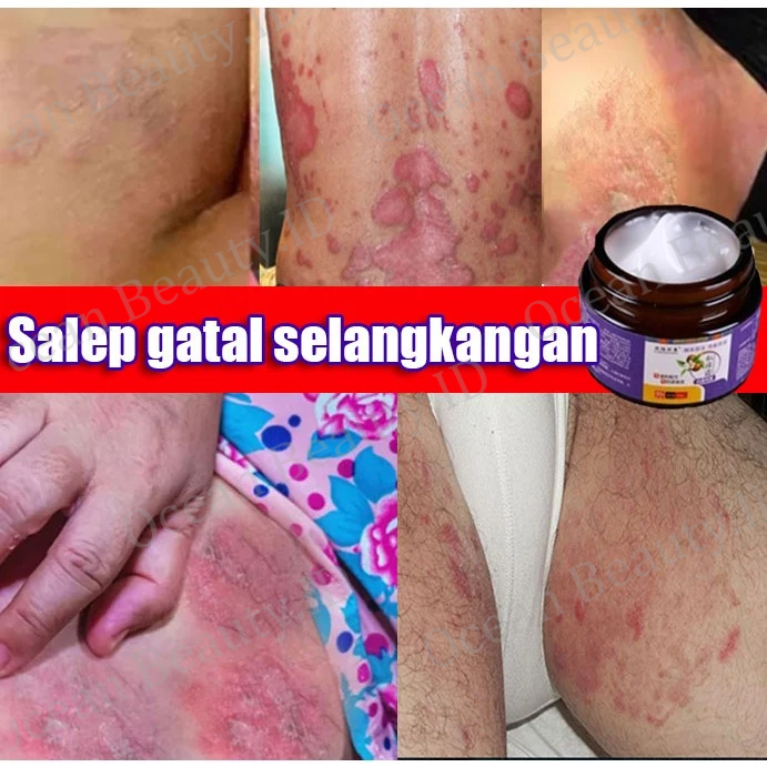 Salep gatal paling ampuh Salep gatal selangkangan Obat selangkangan gatal dan hitam Obat gatal miss 