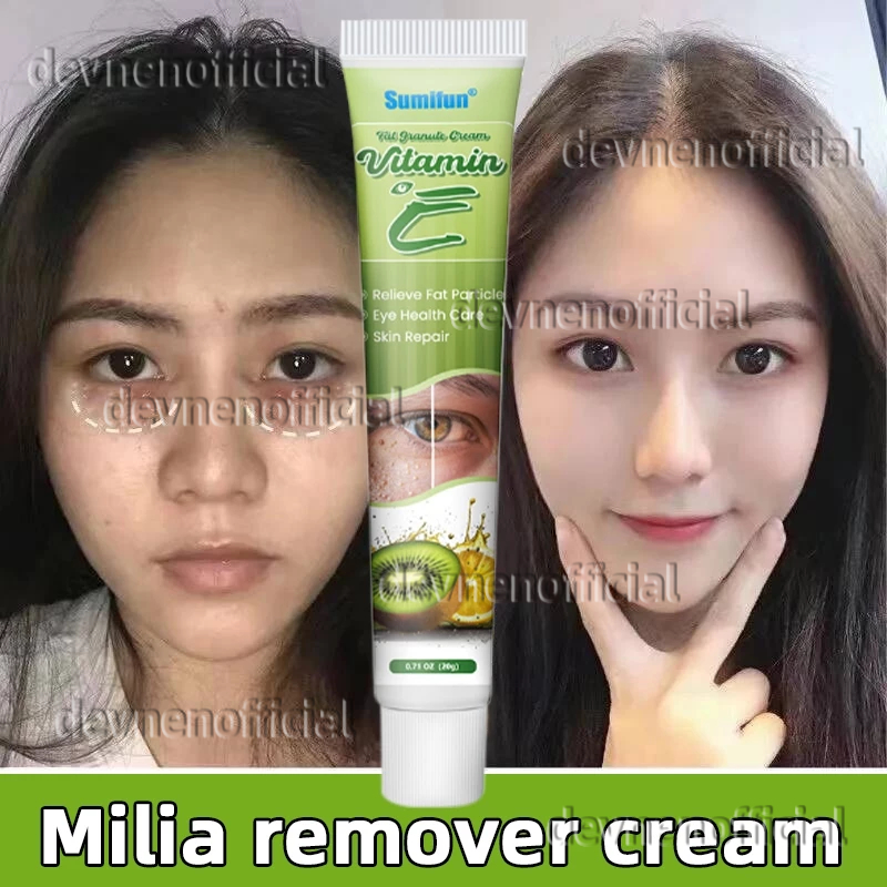 New krim penghilang milia syringoma xanthelasma butiran lemak sekitar mata Milia remover cream 20g
