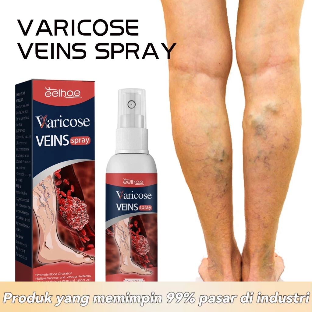 EELHOE Spray Varises Herbal Alami Ampuh Obat Varises Cepat Sembuh Spray Penghilang Varises & Pereda 