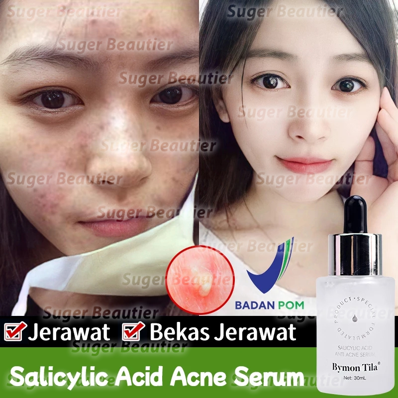 Salicylic Acid Acne Essence 30ML BPOM Serum Jerawat Acnes Penghilang Jerawat dan Bekas Jerawat Salep