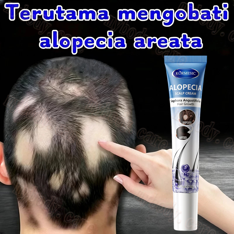 Obat Alopecia Areata Obat Penumbuh Rambut Botak Obat Botak Koin Hair Tonic with Biotin Herbal Obat P