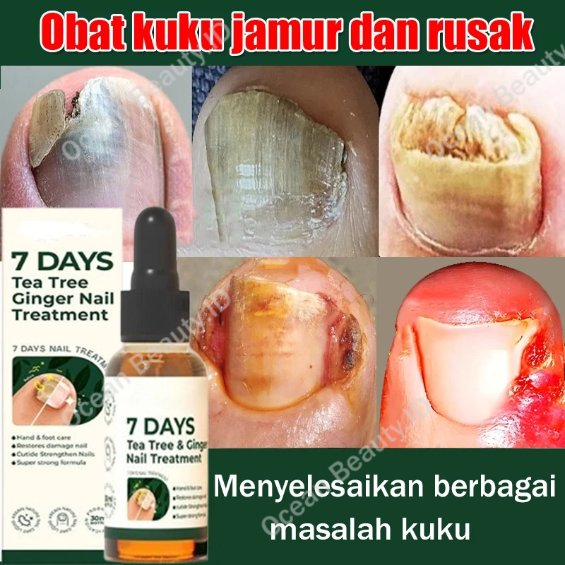Obat Jamur Kuku Serum Kuku Obat cantengan Fungal Nail Treatment Obat jamur kuku kaki Obat Kuku Berja