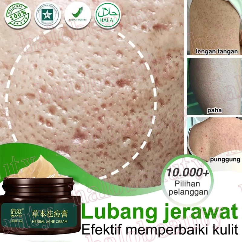 Cream Penghilang Jerawat Penghilang Bekas Jerawat Bopeng Bekas Jerawat Pria Dan Wanita Menghilangkan