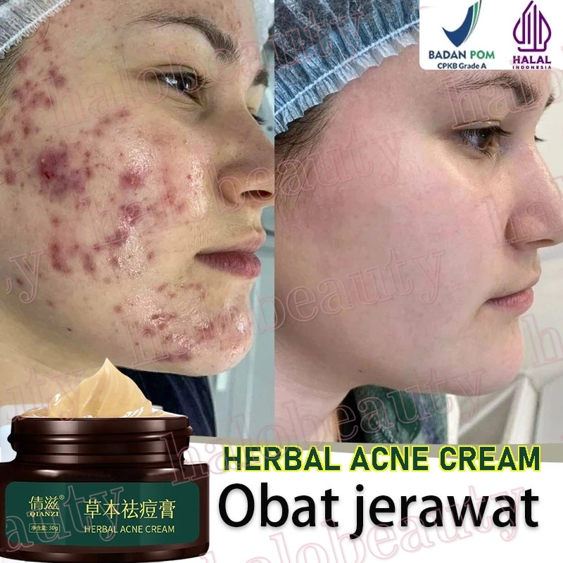 Cream Penghilang Jerawat Penghilang Bekas Jerawat Bopeng Bekas Jerawat Pria Dan Wanita Menghilangkan