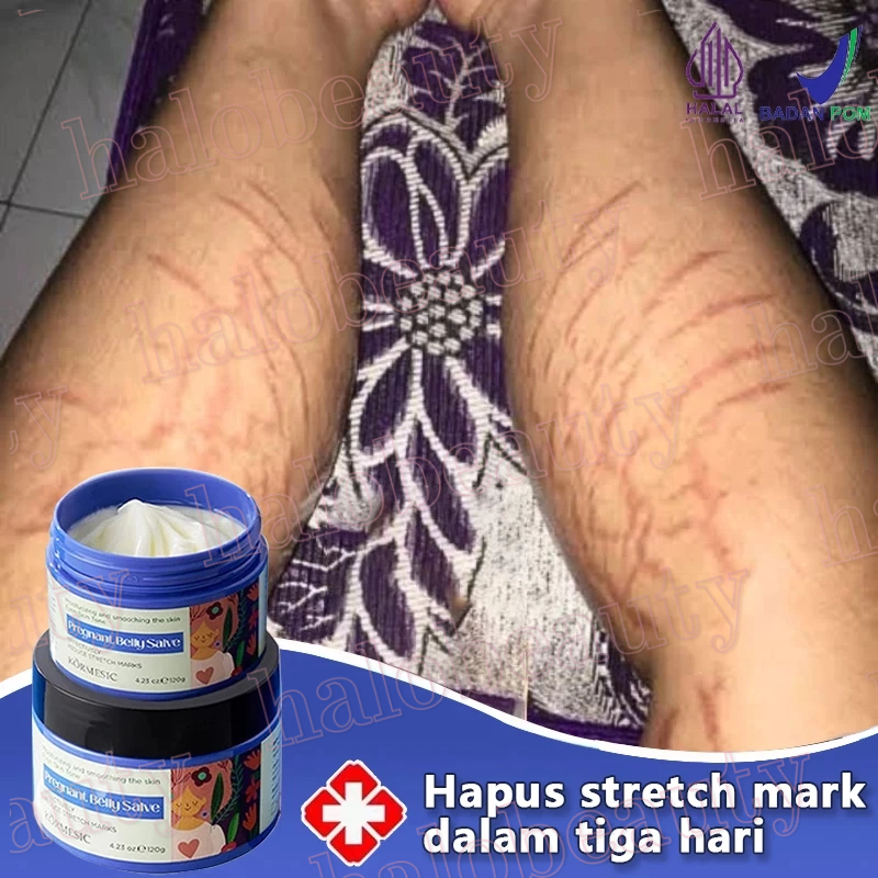 Krim Penghilang Stretch Mark Krim Stretch Mark Ori 100ml  Bpom Stretch Mark Cream Penghilang Bekas L